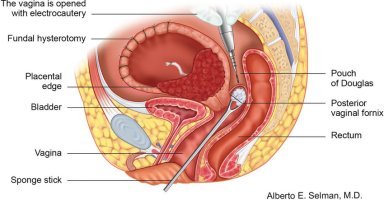 The-posterior-vaginal-fornix-is-exposed-and-the-vagina-is-opened-transversely.jpg