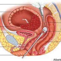 The-posterior-vaginal-fornix-is-exposed-and-the-vagina-is-opened-transversely_Q320.jpg