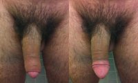 Flaccid_uncut_penis_with_foreskin.jpg